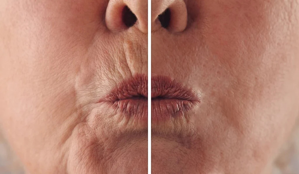 بوتاکس دور لب : راه‌حلی برای جوان‌سازی و رفع چروک اطراف دهان