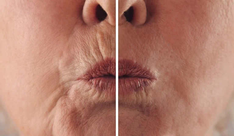 بوتاکس دور لب : راه‌حلی برای جوان‌سازی و رفع چروک اطراف دهان