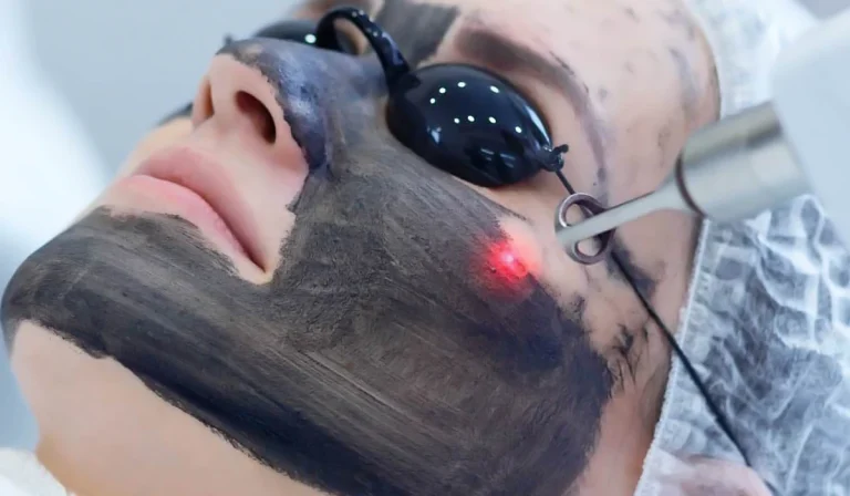 کربن تراپی صورت : راز پوست شفاف، بدون لک و جوان با لیزر کربنی