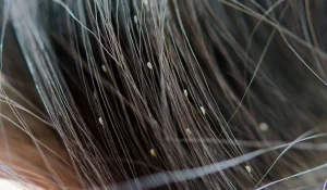 شپش موی سر : مهمان ناخواندهای که باید جدی بگیرید!