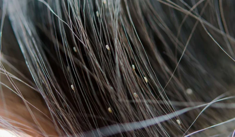 شپش موی سر : مهمان ناخوانده‌ای که باید جدی بگیرید!