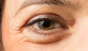 درمان پف زیر چشم با لیزر : بدون جراحی!