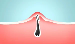 موهای زیر پوستی : چطور با این مشکل برای همیشه خداحافظی کنیم؟