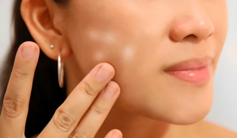 لک سفید روی پوست : دلایل، درمان‌ها و راهکارهای پیشگیری