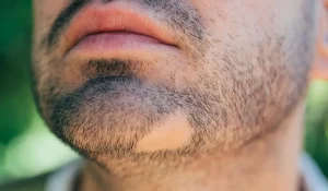 ریزش ریش سکه ای : دشمن خاموش جذابیت مردانه