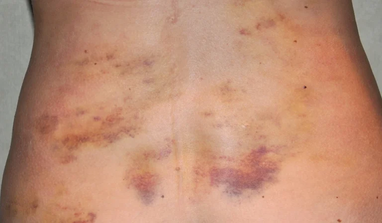 کبودی بعد از لیزر موهای زائد : چه زمانی باید نگران کبودی شد؟