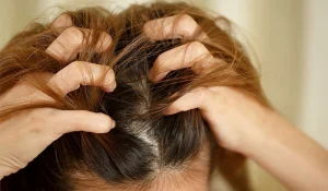 دلایل خارش سر : بررسی علمی علتها و روشهای درمان