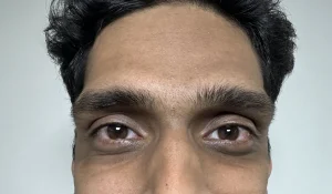 گودی زیر چشم : چرا ایجاد می شود؟ درمان چگونه است؟