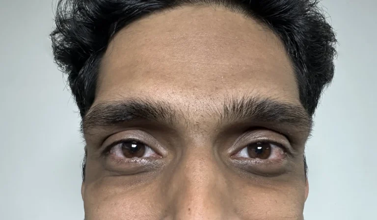 گودی زیر چشم : چرا ایجاد می شود؟ درمان چگونه است؟