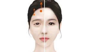 لیفت پیشانی با نخ : کشیدن پوست پیشانی و ابرو بصورت همزمان