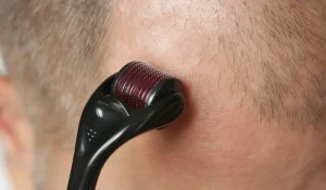 میکرونیدلینگ مو : راهکاری برای توقف ریزش و رشد مجدد مو