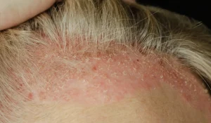 کاشت مو برای بیماران پسوریازیس : نکات مهم برای کاشت یا عدم کاشت