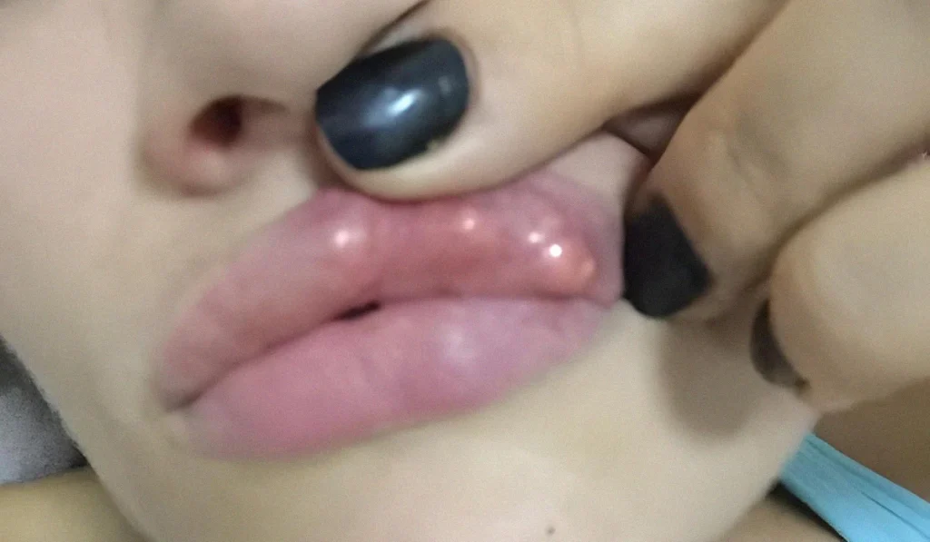 گلوله شدن ژل لب : از تزریق نادرست تا کیفت پایین ژل