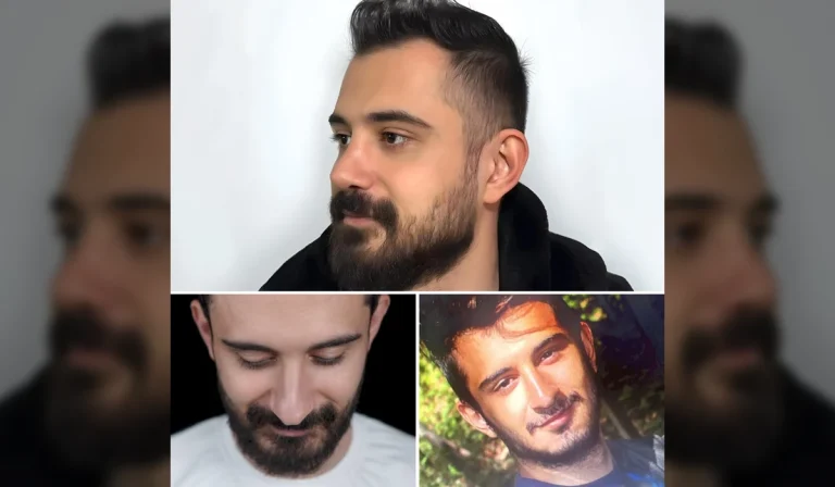 جراحی بینی مردانه و طبیعی : چرا بینی آقایان طبیعی بهتر است؟