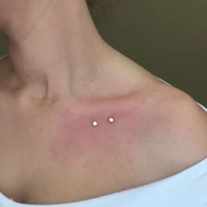 میکرودرمال ترقوه چپ