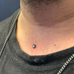 میکرودرمال وسط سینه آقایان