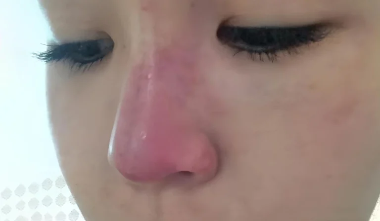 عوارض فیلر بینی : نکات مهم قبل از تزریق