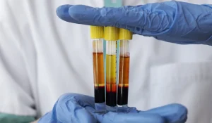 پی آر اف (PRF) : نسل جدید جوانسازی طبیعی و بازسازی بافتهای پوست و مو