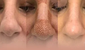 پلکسر بینی : اصلاح فرم بینی بدون جراحی با فناوری پلاسمای سرد