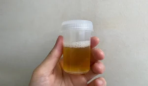 دفع پروتئین از طریق ادرار : نشانهای جدی از بیماری پنهان در بدن