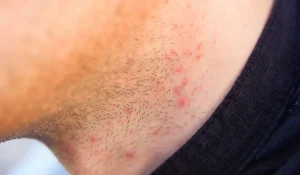 درمان سریع جوش بعد از اصلاح صورت با چه روشهایی امکان پذیر است؟