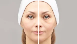 فیلر ناودان اشکی : رفع تیرگی و شاداب کردن ناحیه چشم