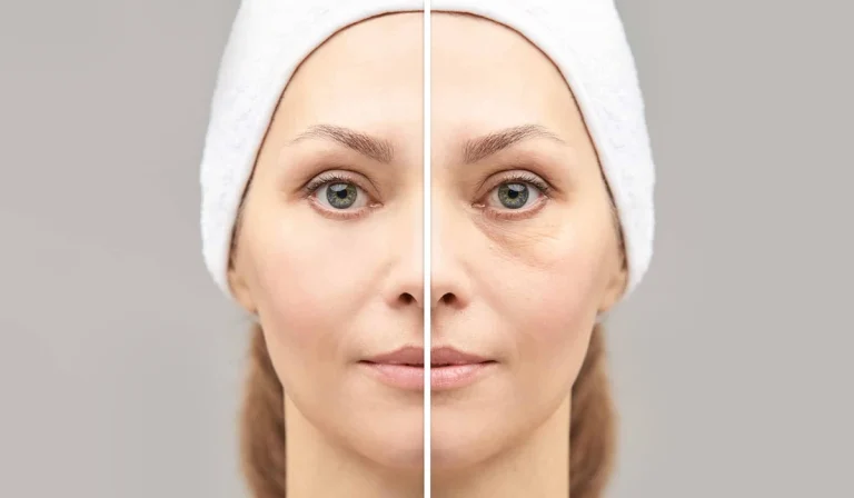 فیلر ناودان اشکی : رفع تیرگی و شاداب کردن ناحیه چشم