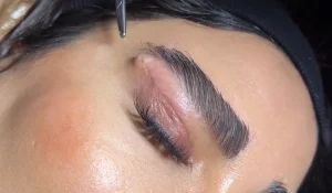 درمان جای بخیه بعد از بلفاروپلاستی : برای ترمیم سریع چه کنیم؟