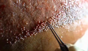 بهترین روش کاشت مو : معیار انتخاب درست چیست؟