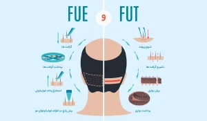 تفاوت کاشت مو به روش FUE و FUT : کدام روش مناسب تر است؟