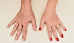 پی آر پی دست : راه حل طبیعی برای جوانسازی دستان پیر و چروک