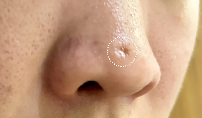 سابسیژن بینی : رفع فرورفتگی‌ها و نقایص جزئی بینی بدون جراحی