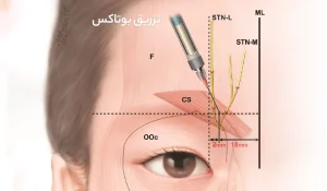 بهترین روش تزریق بوتاکس برای نتایج طبیعی و ماندگار