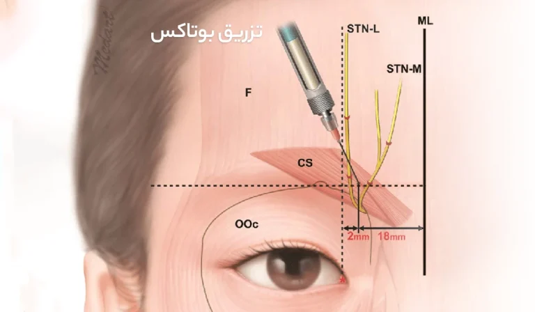 بهترین روش‌ تزریق بوتاکس برای نتایج طبیعی و ماندگار