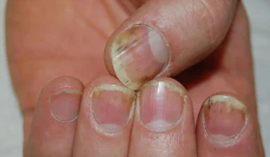 پسوریازیس ناخن : راههای کنترل این بیماری پوستی مقاوم