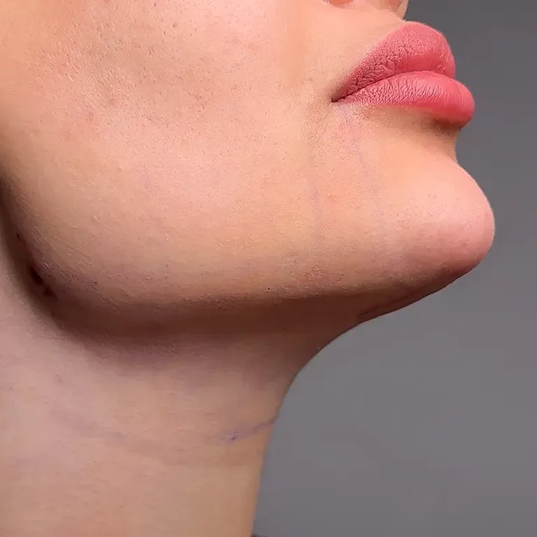 v-line_lipo.webp
